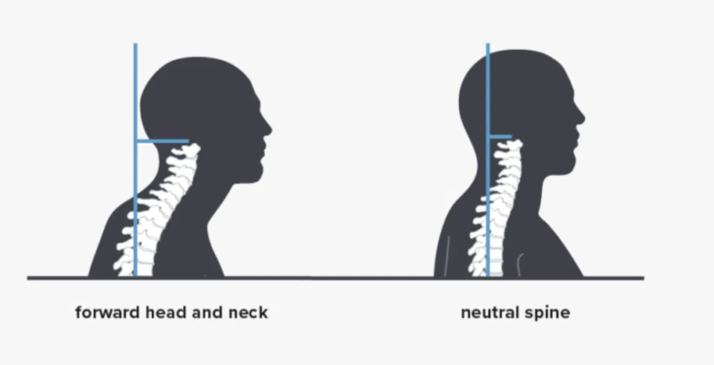 Types of postural defects. Bad posture names