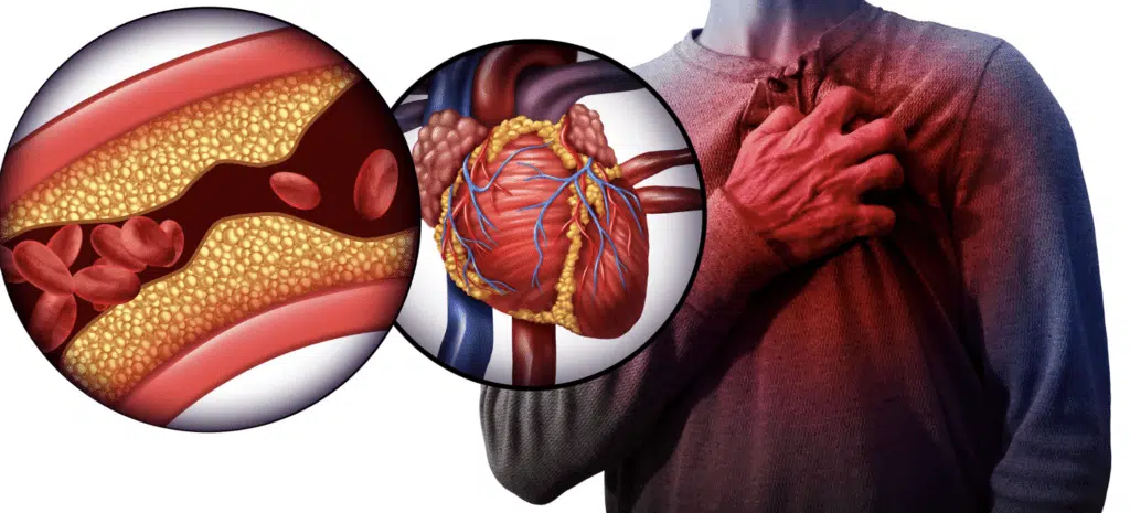 Cholesterol and Heart Disease